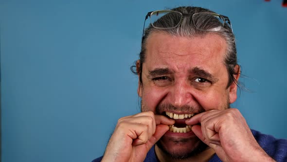 Patient a Mouth Output Temporary Crowns Taken From with Analogues of Implants alt