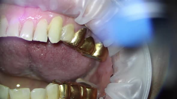 dentistry.removal of the gold bridge of the upper jaw using a hook