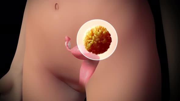 Uterus with endometriosis animation. Fertility, human anatomy, female reproductive system. alt