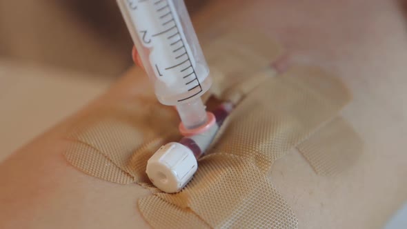 Closeup on the Hand of a Syringe with a Catheter Injection of Medication Dropper