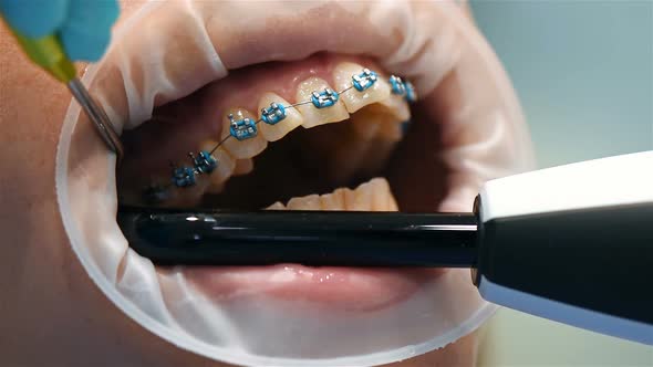 Dentist Fixes Braces