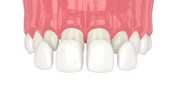 Upper jaw with installing dental veneers