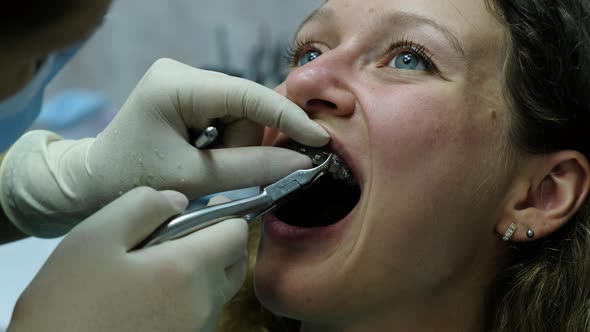 Visit To the Dentist Installation of the Bracket System Orthodontist Establishes a Metal alt