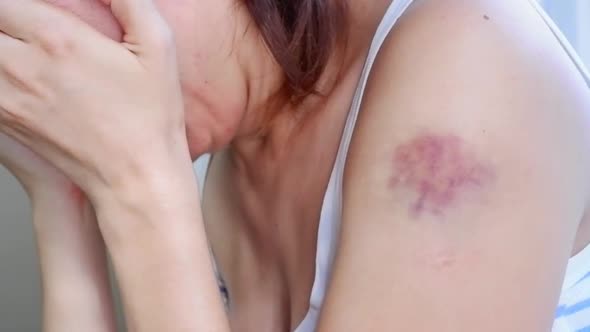 A Woman in a Whiteblue Tshirt with a Bruise on Her Arm After the Beatings is Crying in Pain Covering
