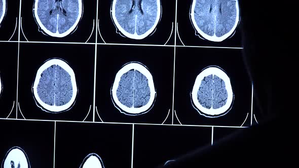 Medical scientist zooms CT, MRI brain scan images on a big sensor screen.