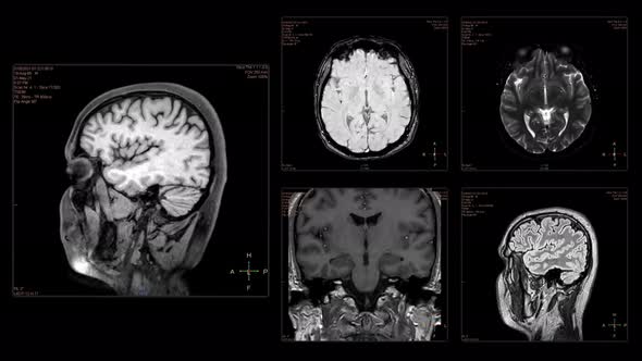 Head MRI scan from different angles