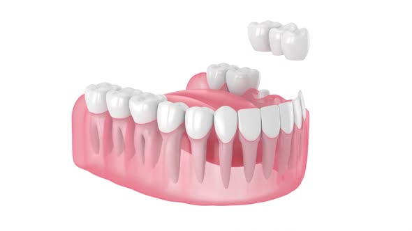 Jaw with dental bridge over molar and premolar teeth