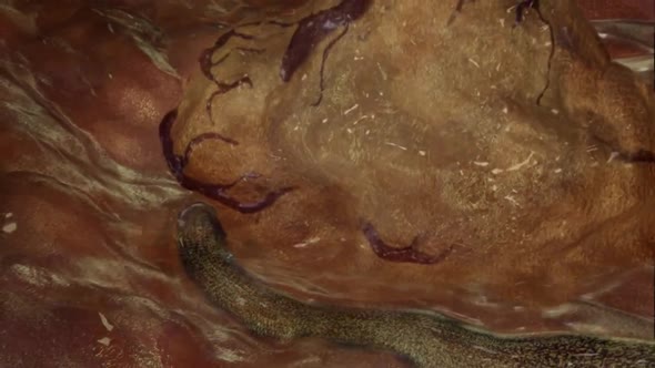 destructionofthetumor.mov alt