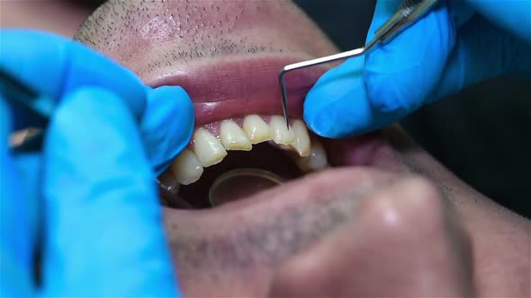 Dental Implantation Procedure