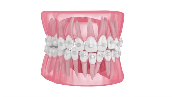 Teeth alignment by orthodontic clear ceramic braces isolated over white background