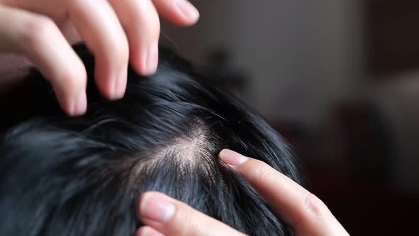 Man split their hair to reveal hair loss