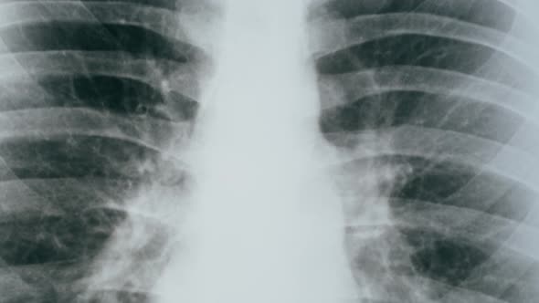Lungs Xray Closeup alt
