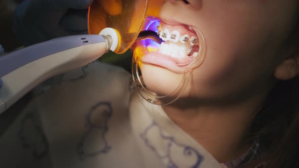Orthodontist Shines on the Teeth with a Photopolymer Lamp alt