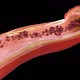 Atherosclerosis - Plaque build up from cholesterol - VideoHive Item for Sale