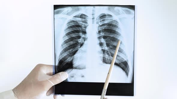 Tuberculosis On A Human Lung X Ray. The Doctor Analyzes An X Ray Of The Lungs On A White Background