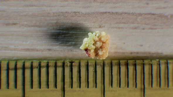 Oxalate Kidney Stone, Stone Removed From Kidney, Kidney Stone Natural alt