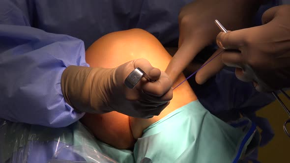 Knee Surgery or Anterior Cruciate Ligament Reconstruction 6