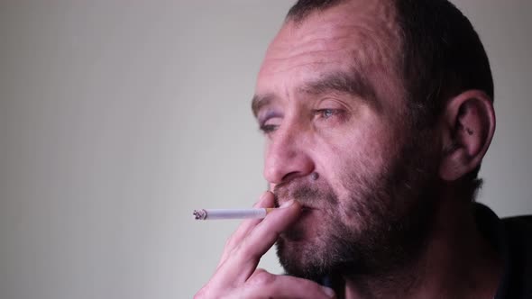 A Man with Alcohol Dependence He Has a Hematoma on His Face alt