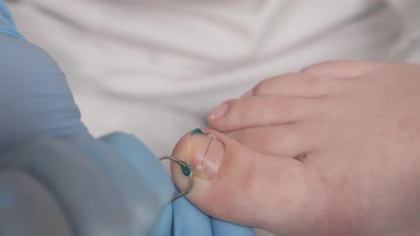 Podiatrist installs a titanium thread at big toenail and using medicine ...