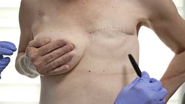 Preparing for Breast Reconstruction for a Woman Undergoing Mastectomy alt