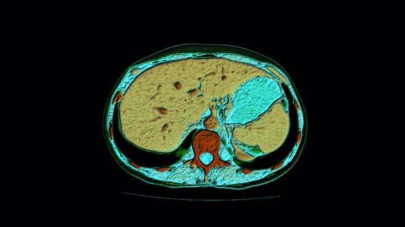 Color Contrast MRI of the Abdominal Cavity, Gastrointestinal Tract, Bladder alt