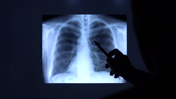 A doctor with a pen checks a medical x-ray of lungs with pneumonia on a big black screen.