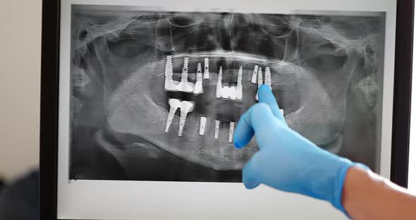 a Dentist's Hand in a Blue Medical Glove Points a Finger at an Xray of a Patient alt