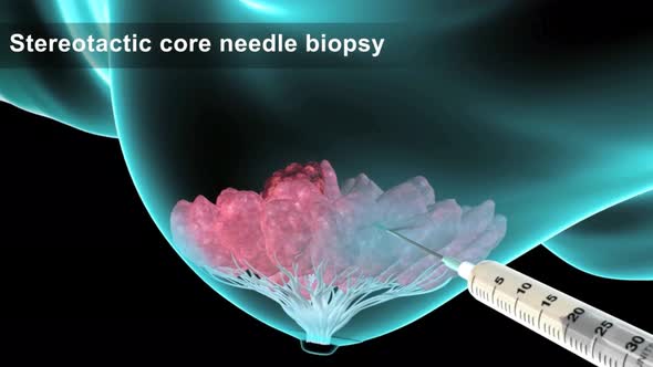 A sample is taken to examine the tumorous breast. Biopsy alt