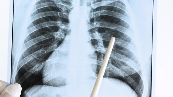 Tuberculosis On A Human Lung X Ray. The Doctor Analyzes An X Ray Of The Lungs On A White Background