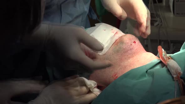 Face and Neck Liposuction for Man 4