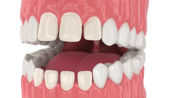 Human jaw with dental veneers installation