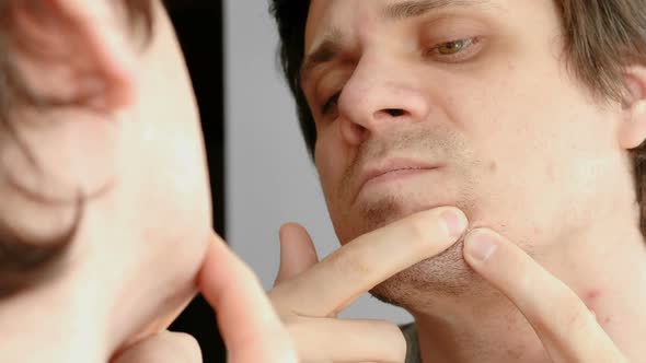 Young Man Squeezes the Pimple on the Face in Front of the Mirror.  Man's Face with Skin Problems.