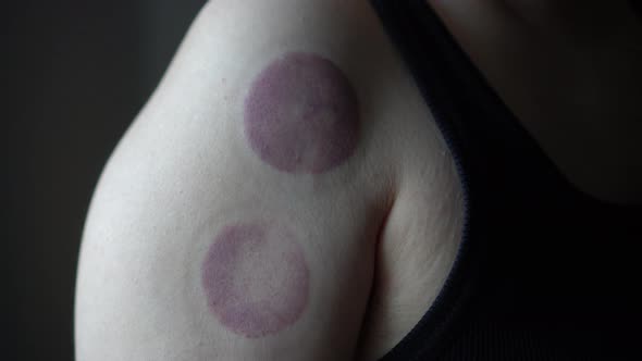 Bruise Marks From Suction Cups Alternative For Blood Circulation And Pain Relief Therapy