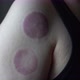 Bruise Marks From Suction Cups Alternative For Blood Circulation And Pain Relief Therapy - VideoHive Item for Sale