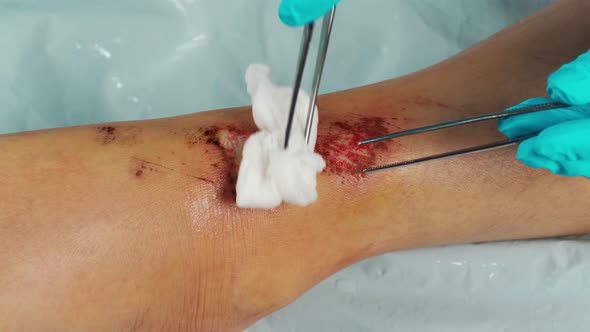close up doctor cleaning wound on the leg by alcohol, Injuries from falling alt
