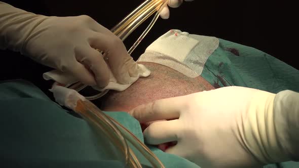 Face and Neck Liposuction for Man 3