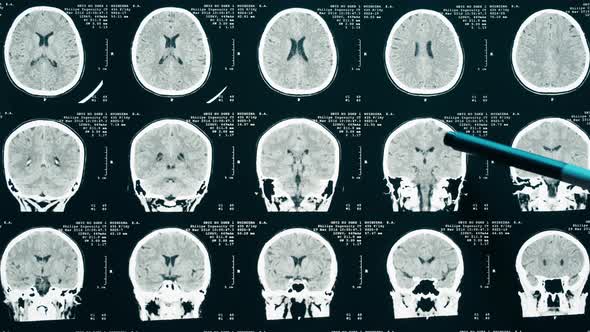 Xray Magnetic Resonance Image of Head alt