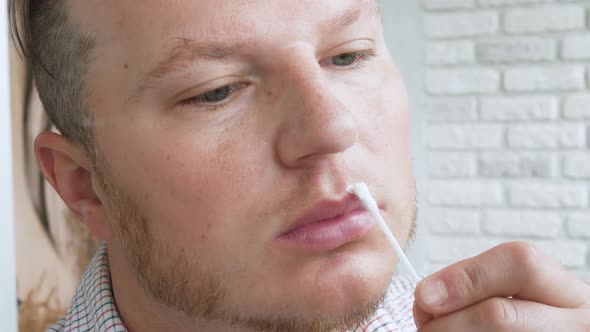 A Young Man Rubs Ointment On A Wound On His Lip. Herpes On The Lip Of A Man.