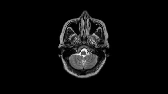 Computed Tomography of the Brain
