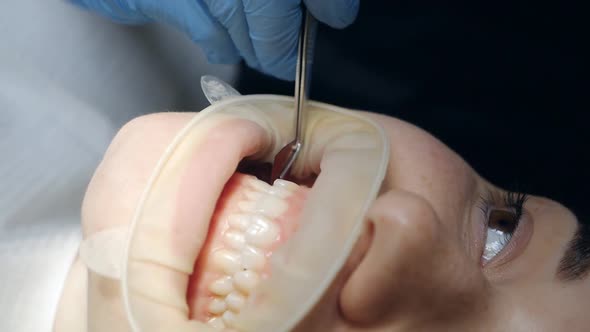Closeup of a Dentist's Hand in Medical Gloves Works with a Patient in a Dental Office