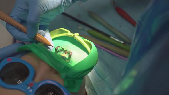 Dentist Uses Cofferdam for Treatment Caries and Tooth Reconstruction of a Child alt