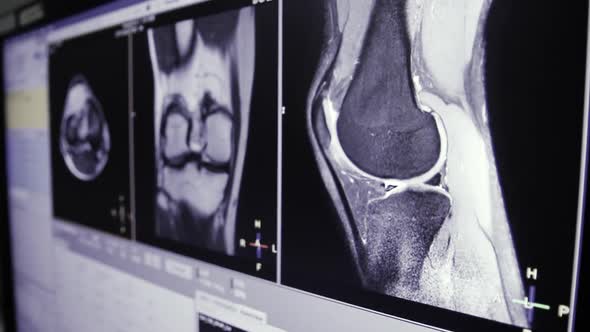 MRI Knee Joint or Magnetic Resonance Imaging of the Knee for Diagnosis Trauma