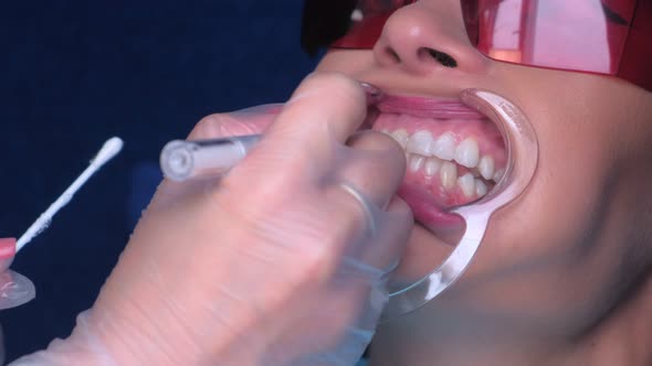 Nurse Applying Gel for LED Whitening Woman Patient Teeth in Dentistry Closeup