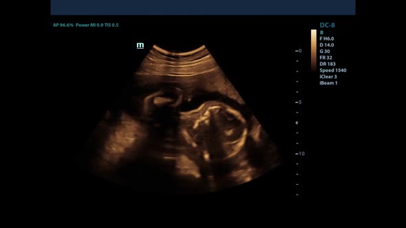 A small child in the mother's stomach. The result of ultrasound of a pregnant girl. Ultrasound alt