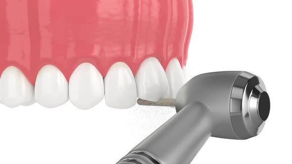 Upper jaw with dental veneer placement alt