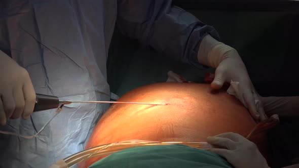 Liposuction And  Belly Fat 7