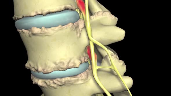 Spinal stenosis is the narrowing of the bony canals through which the ...