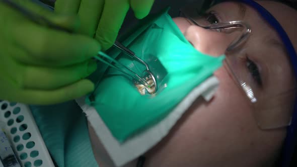 Closeup Face of Young Woman with Dentist Hands Cleaning Tooth Hole Reflecting in Dental Mirror alt