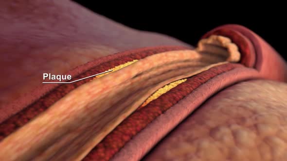 Coronary artery spasm is a brief, sudden narrowing of one of these arteries. alt