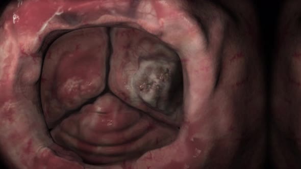 Cardiac tumors are abnormal growths in the heart or heart valves. alt